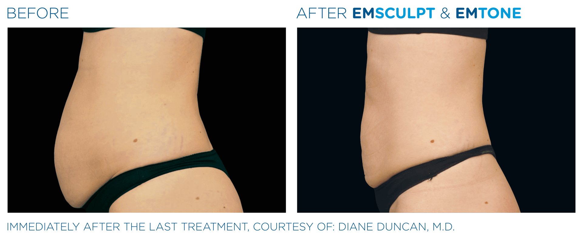 A before and after picture of a woman 's stomach