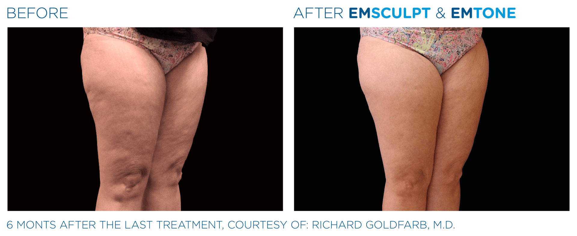 emsculpt before and after photos