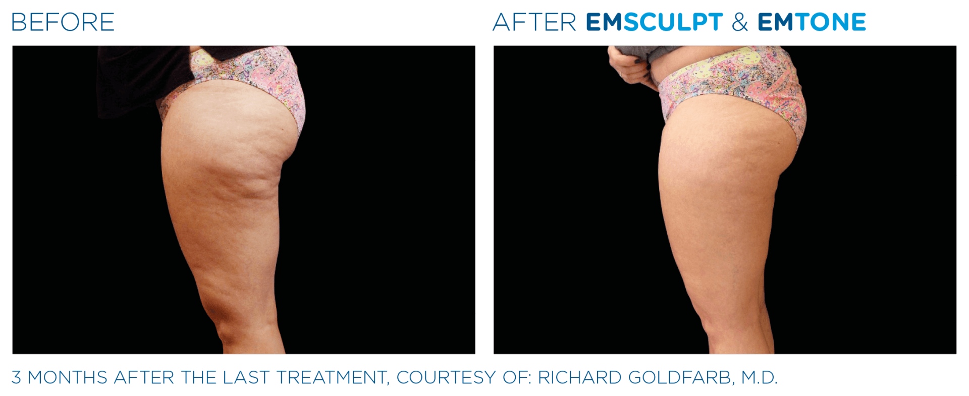 skin tightening and cellulite reduction using emsculpt before and after photos