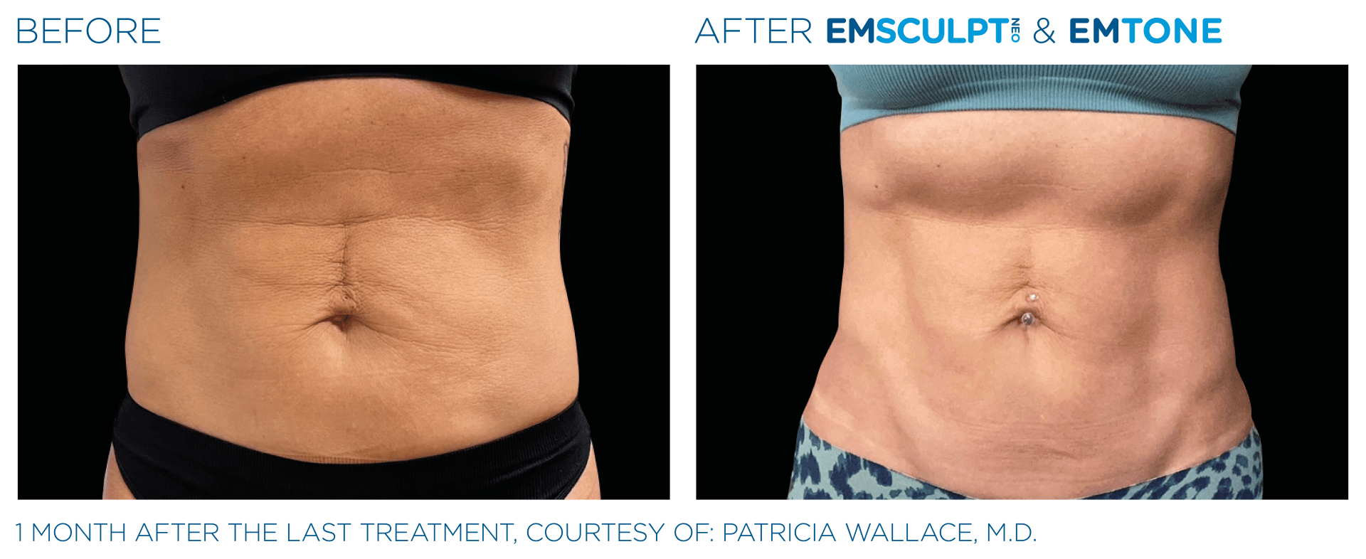 A before and after picture of a woman 's stomach.