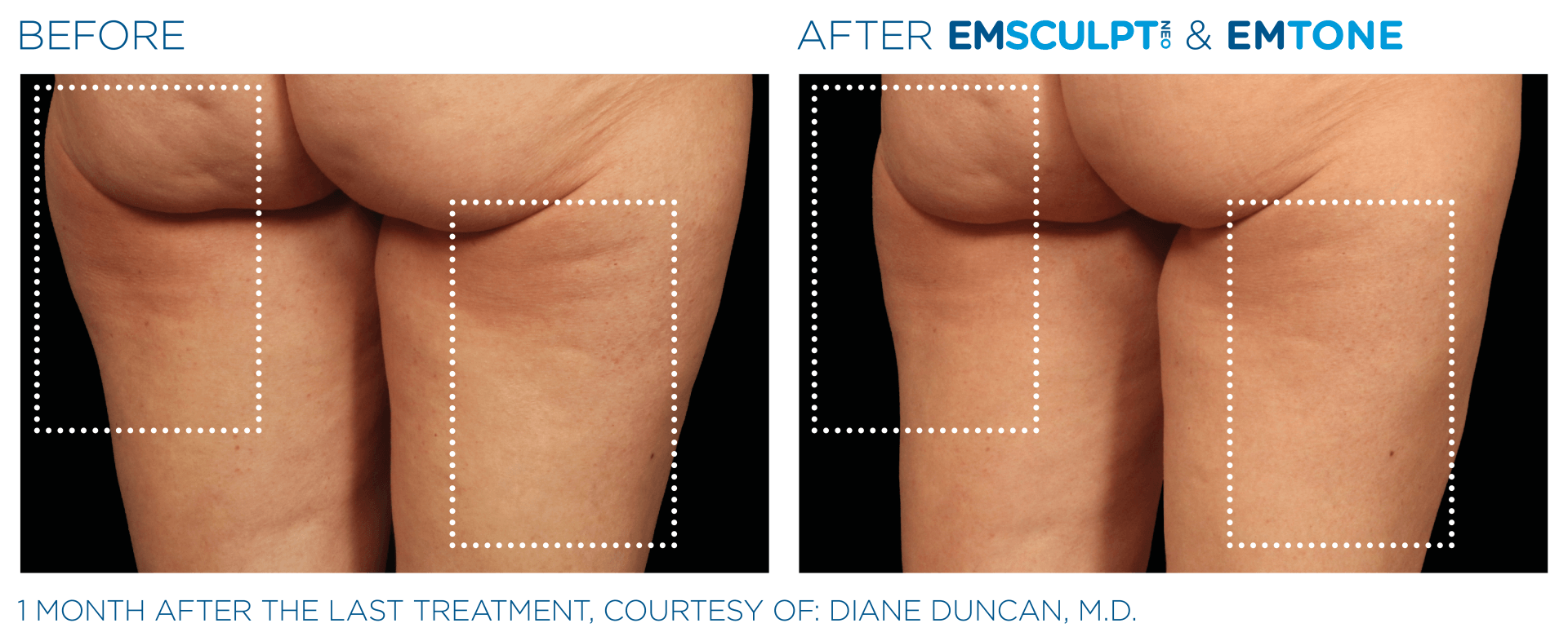 emsculpt - muscle building and body sculpting before and after photo