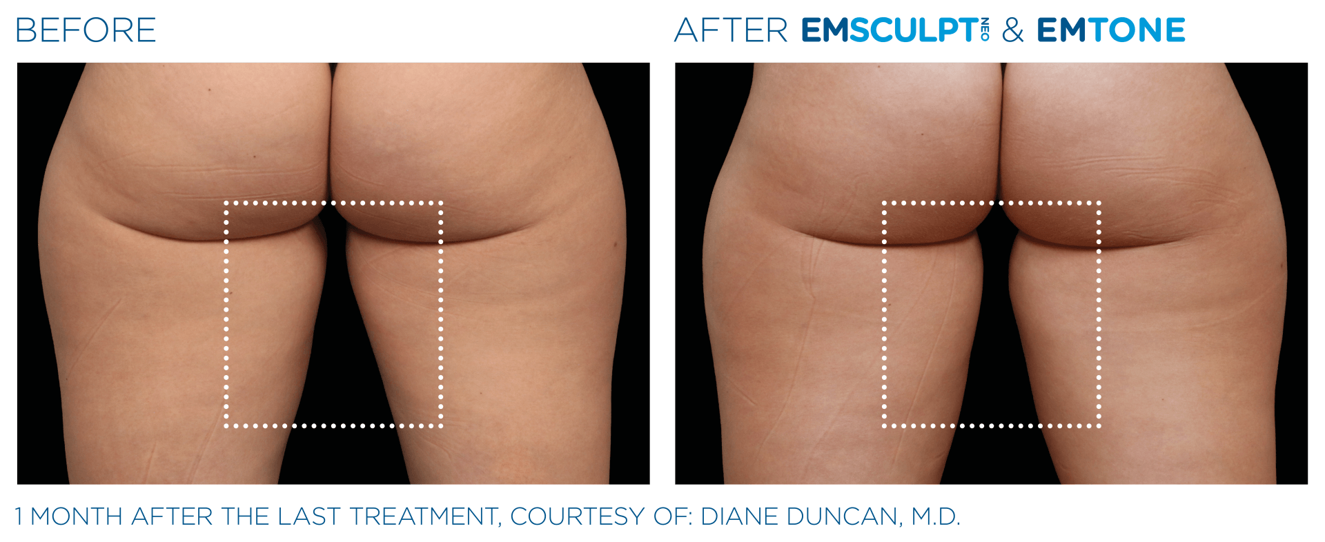 muscle building / body sculpting with emsculpt - before and after photos