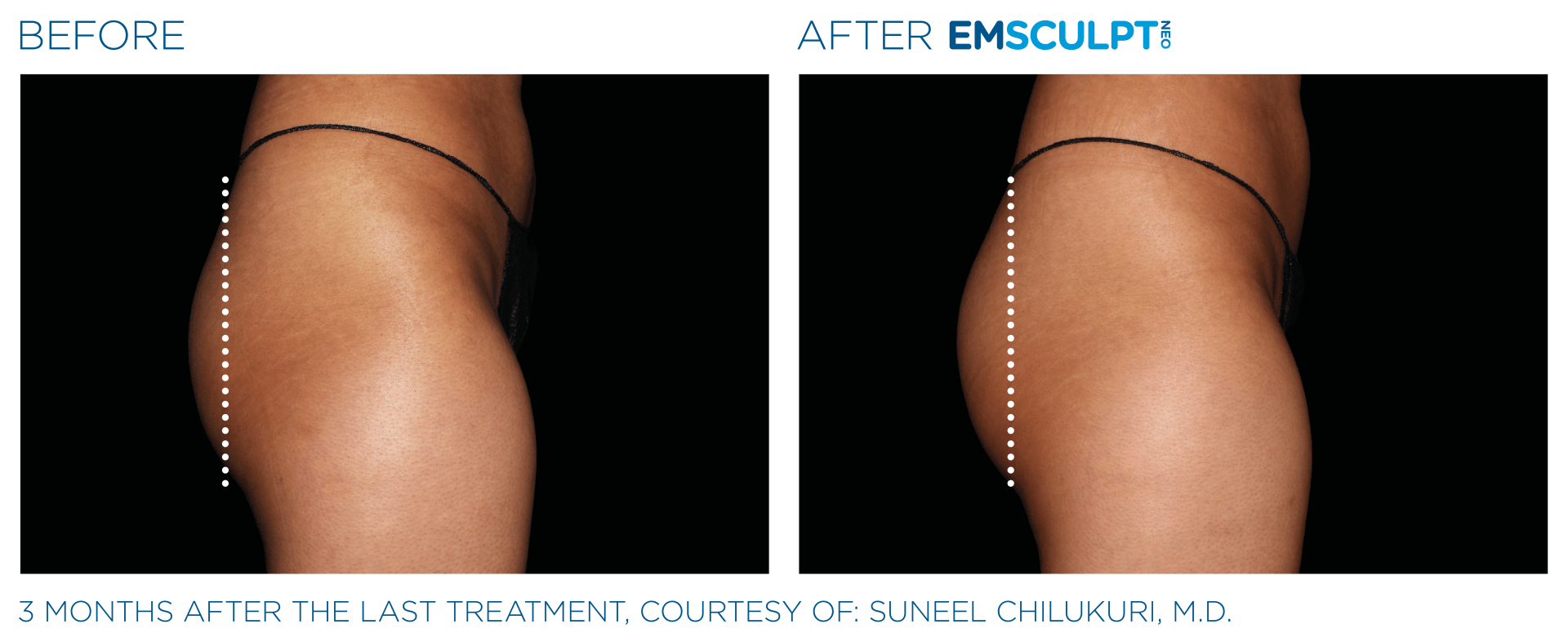 before and after body contouring and fat reduction treatments