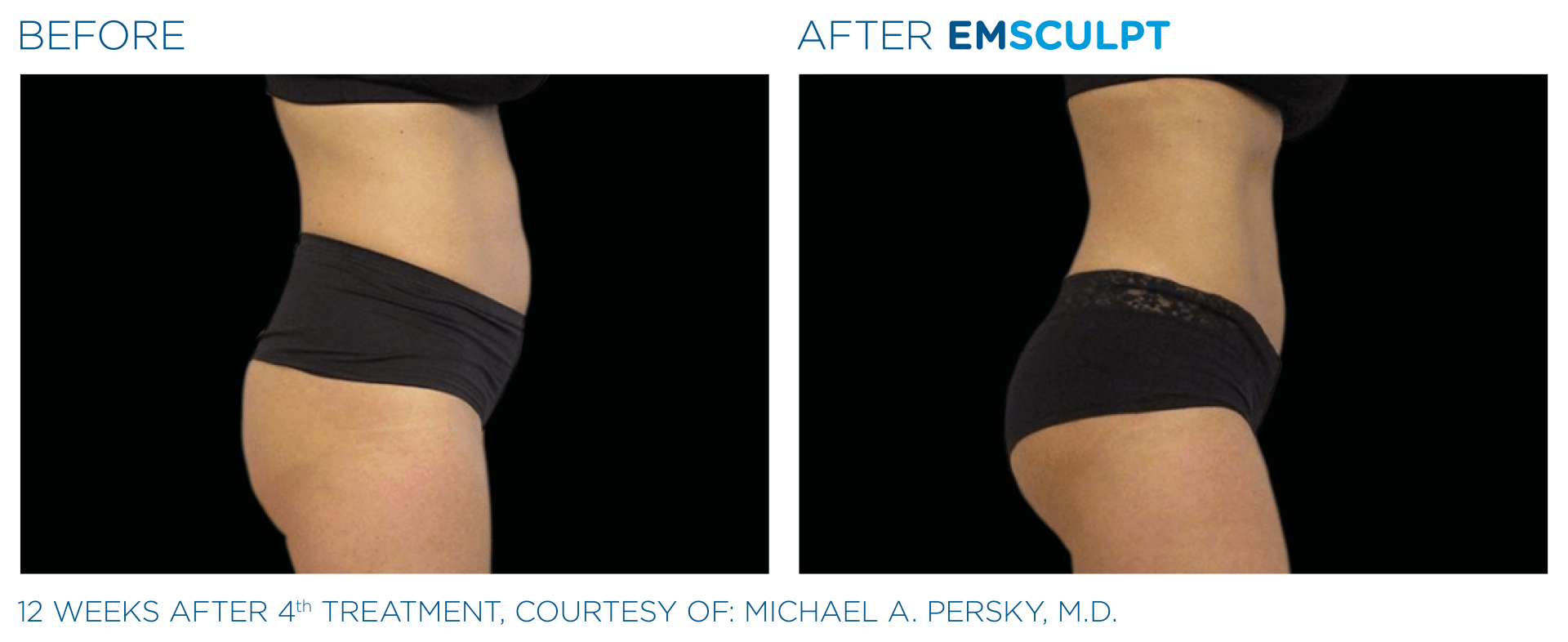 before and after treatment for muscle and body sculpting