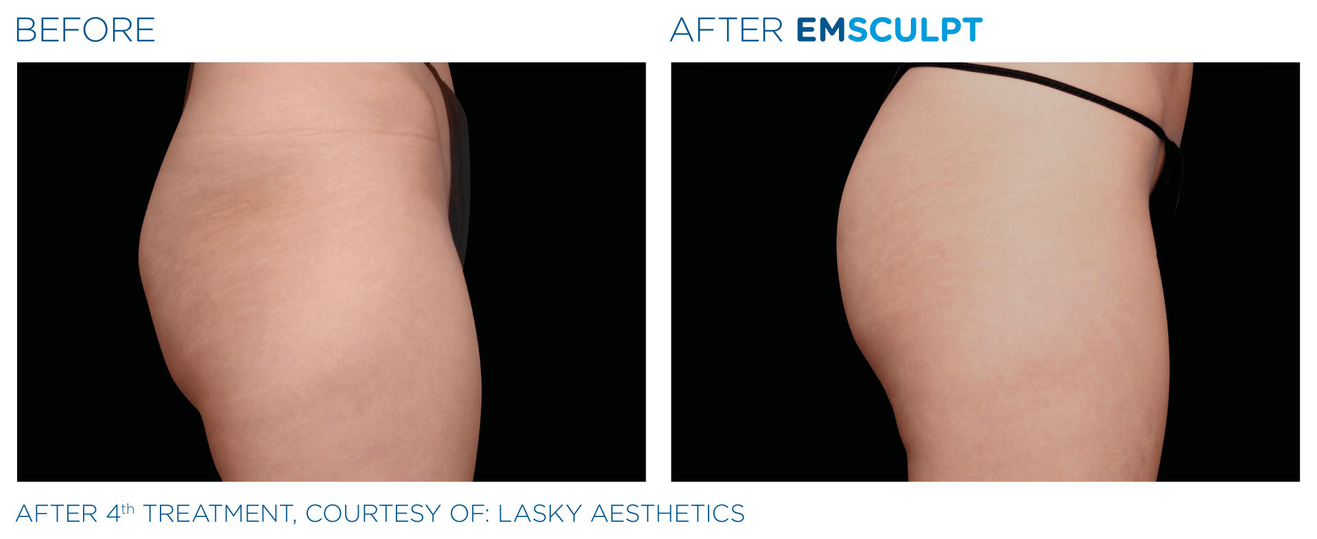before and after body contouring and fat reduction treatments