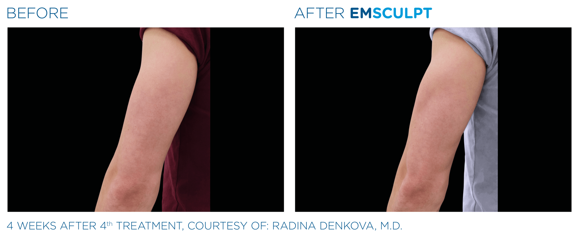 A before and after picture of a person 's arm