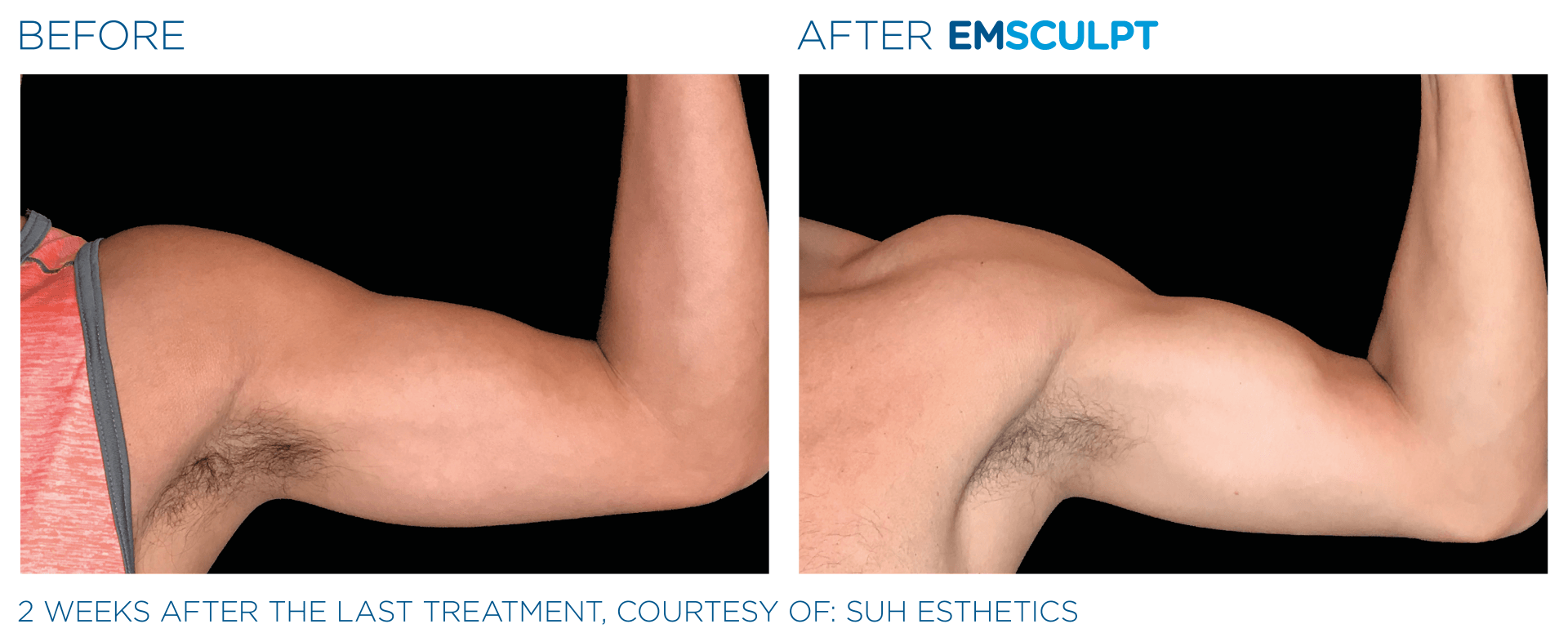 before and after body sculpting treatments