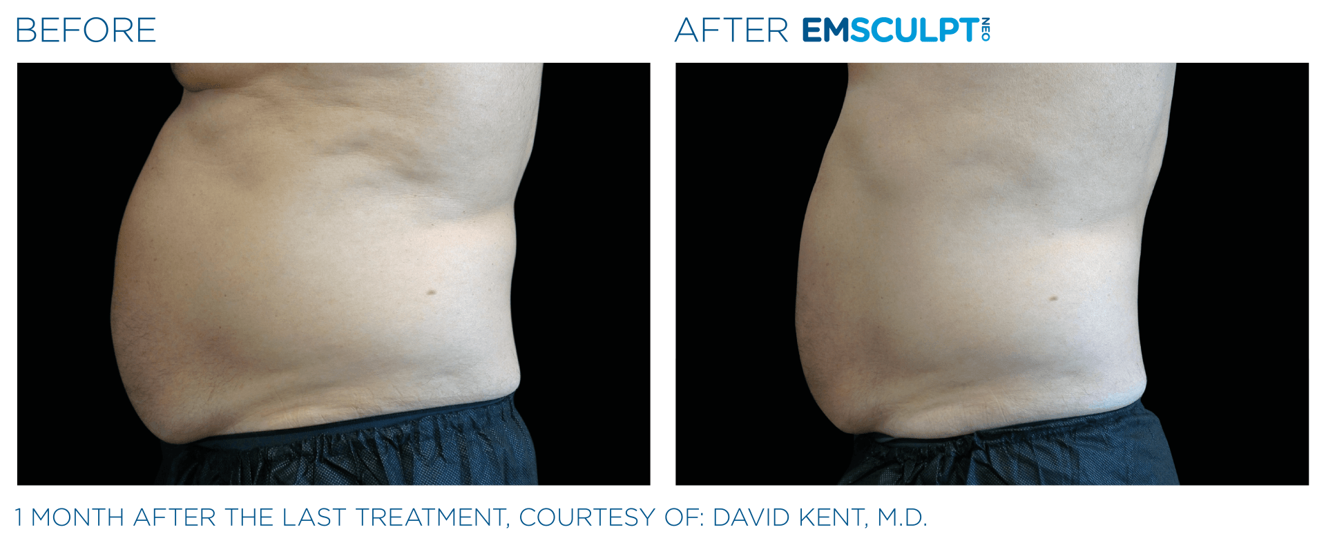 A before and after picture of a person 's stomach