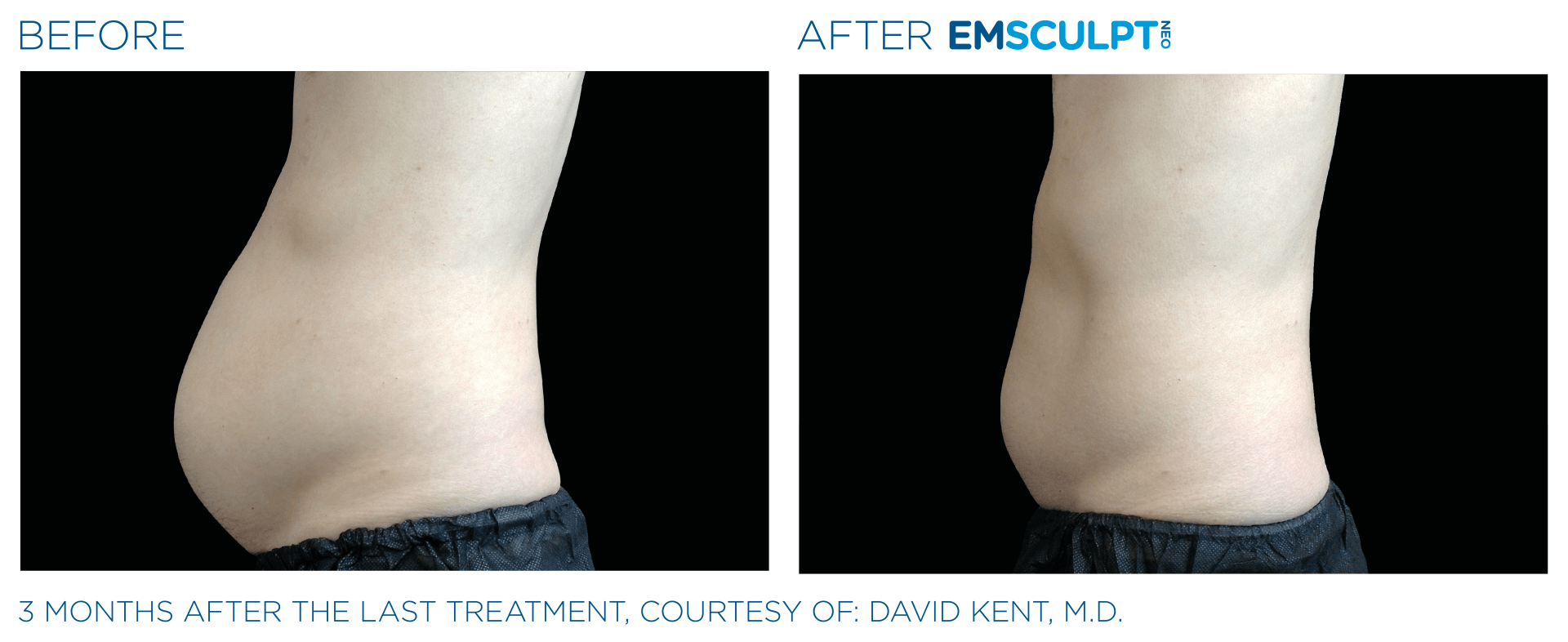 A before and after picture of a person 's stomach