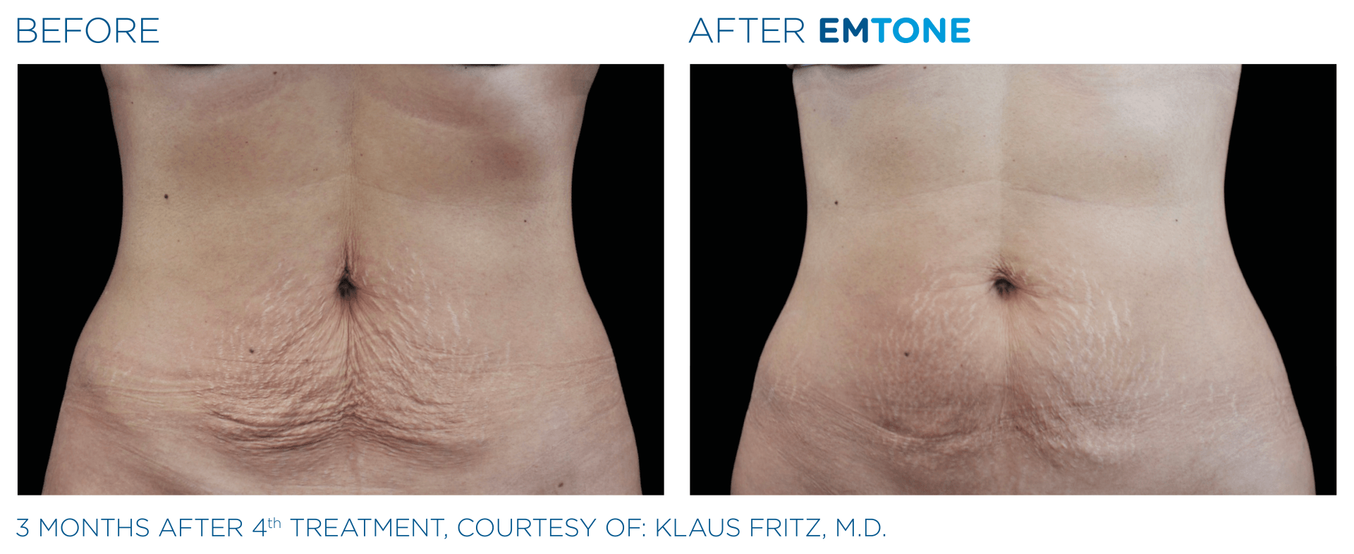 A before and after picture of a woman 's stomach