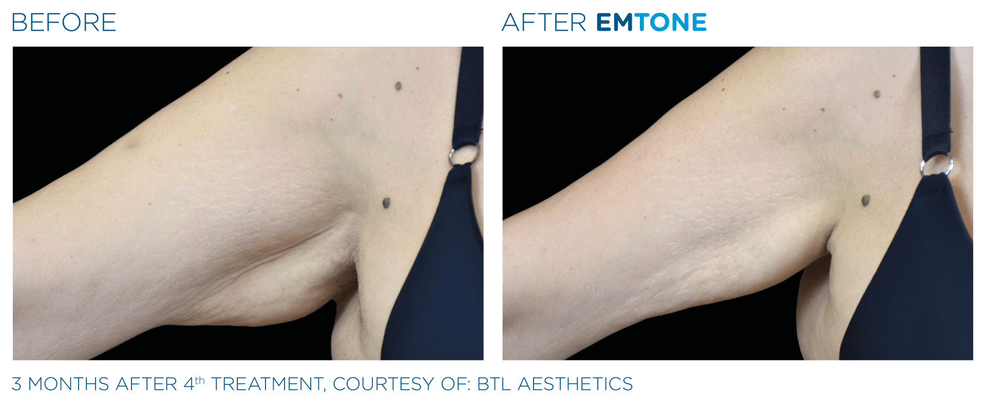 A before and after photo of a woman 's arm