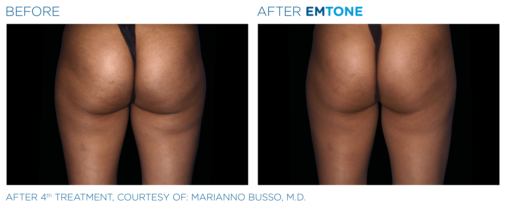 Skin tightening and cellulite reduction before and after photos