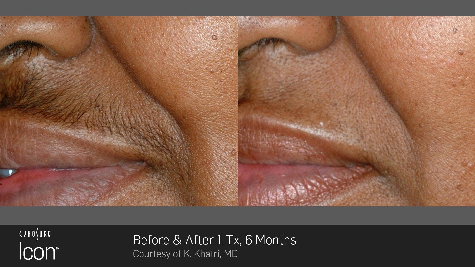 before and after laser hair removal treatments