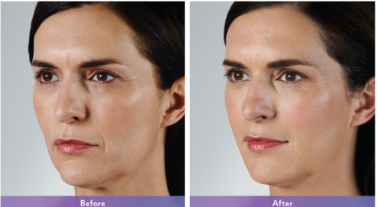 A before and after photo of a woman 's face.