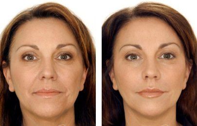 A before and after photo of a woman 's face.