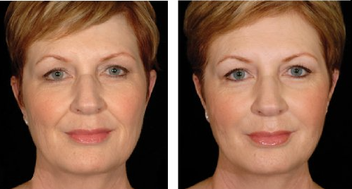 A before and after photo of a woman 's face.