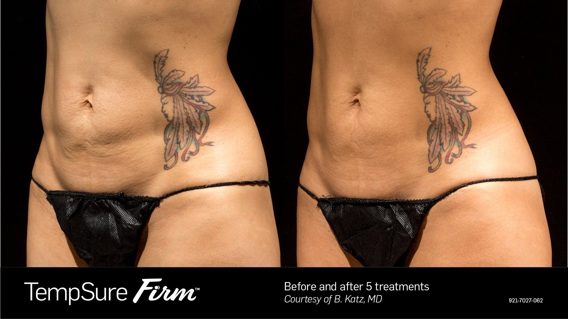 before and after cellulite reduction and skin tightening treatment