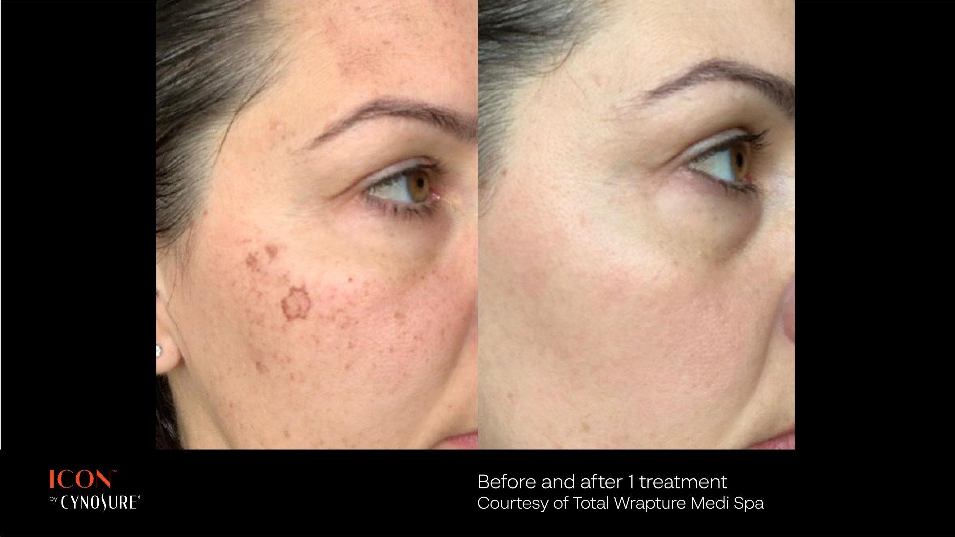 A before and after photo of a woman 's face