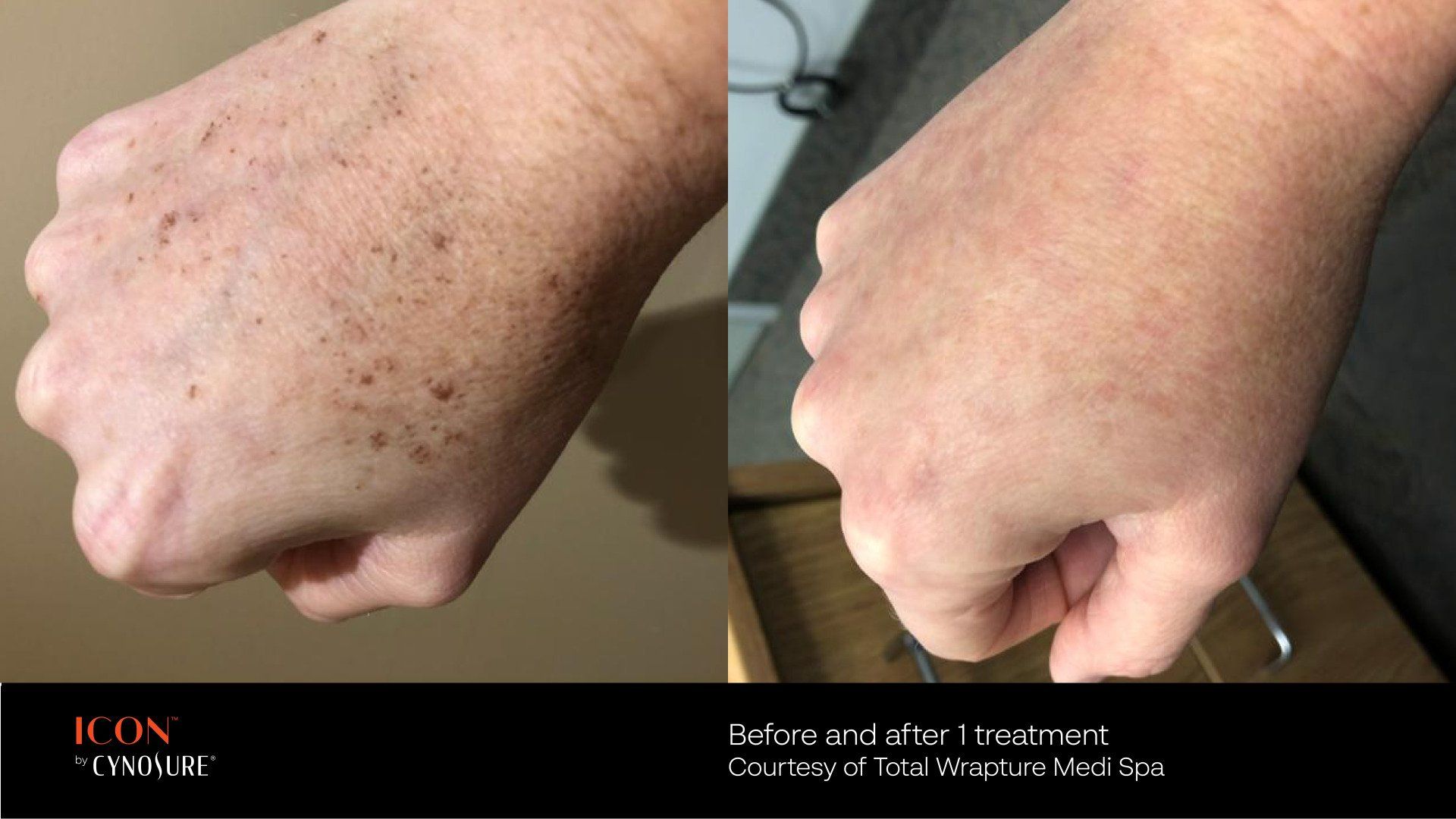 A before and after photo of a person 's hand
