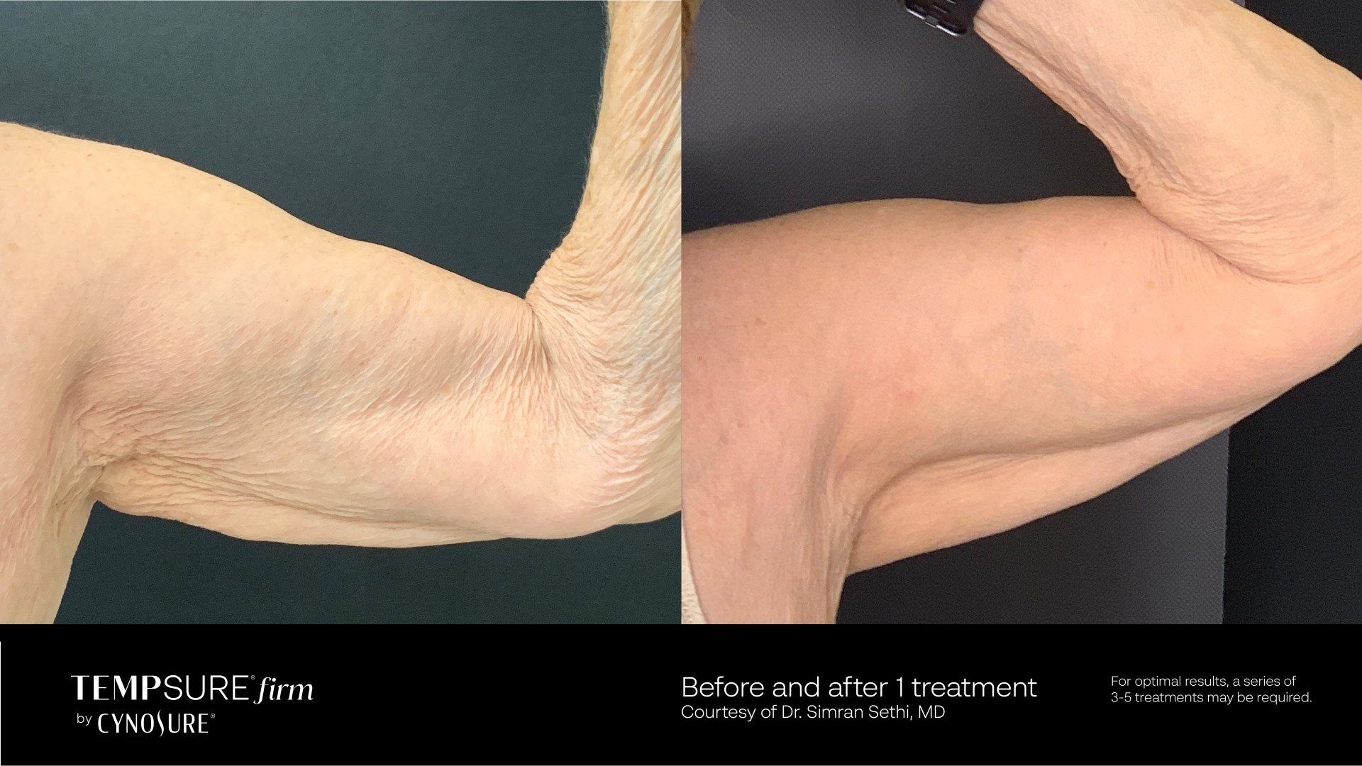 before and after cellulite treatment
