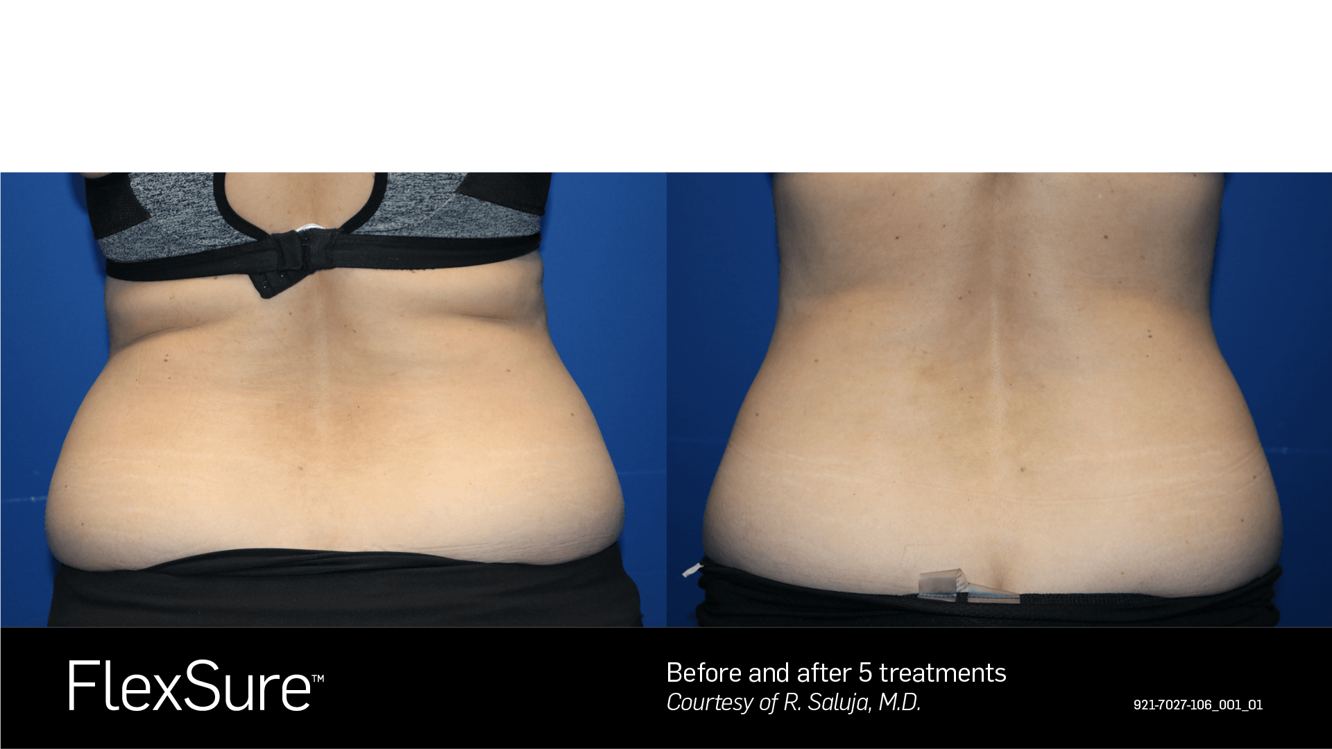 A before and after picture of a woman 's lower back