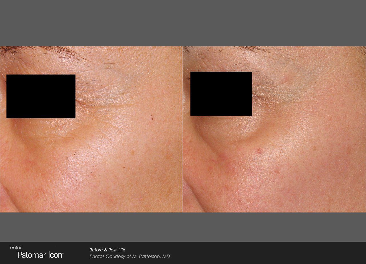 A before and after photo of a woman 's face