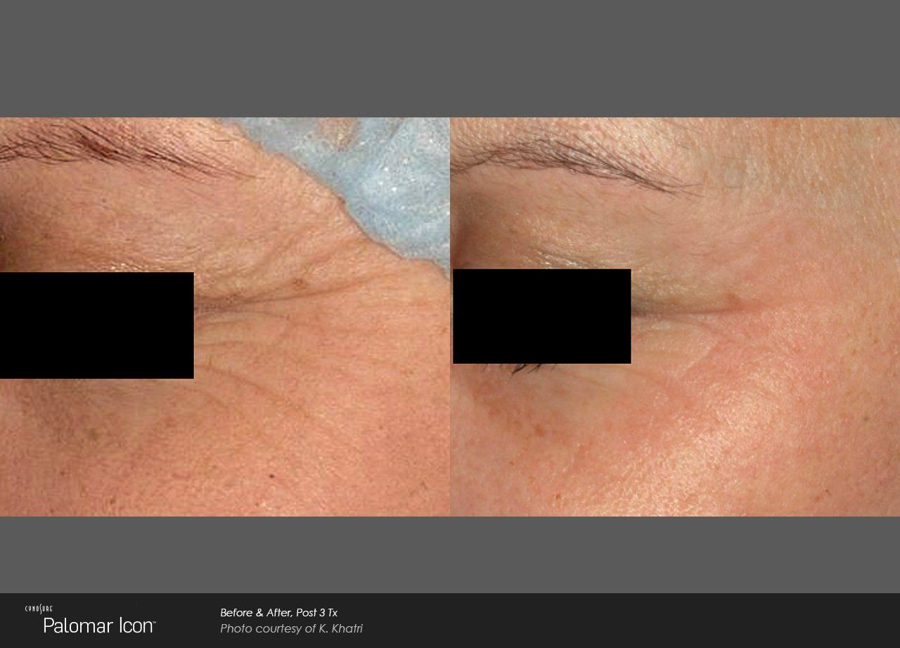 A before and after photo of a woman 's face with wrinkles.