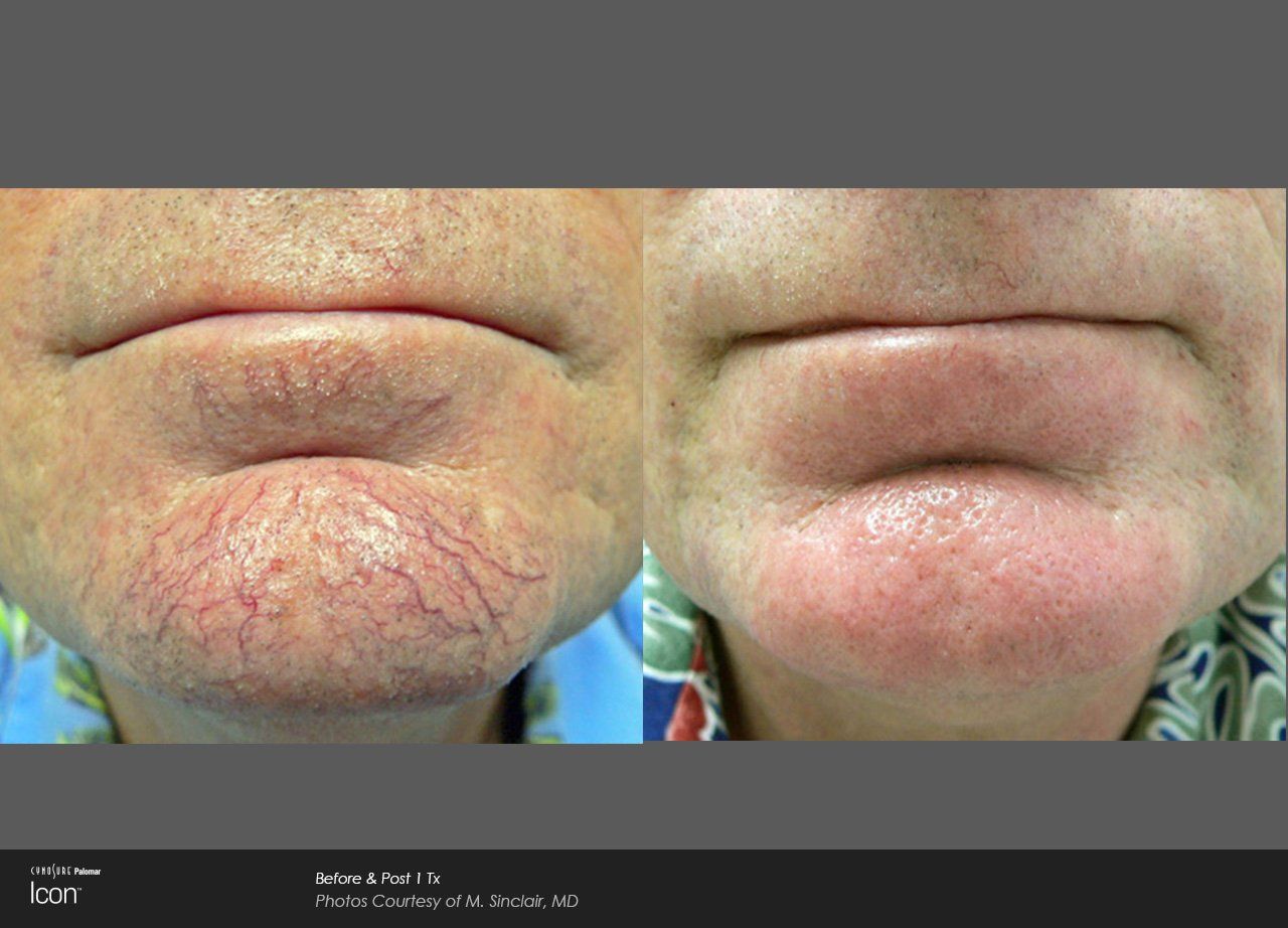A before and after photo of a woman 's face with red veins.