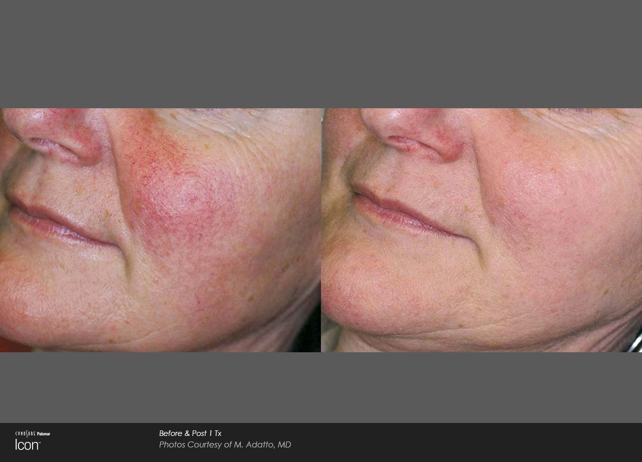 A before and after photo of a woman 's face