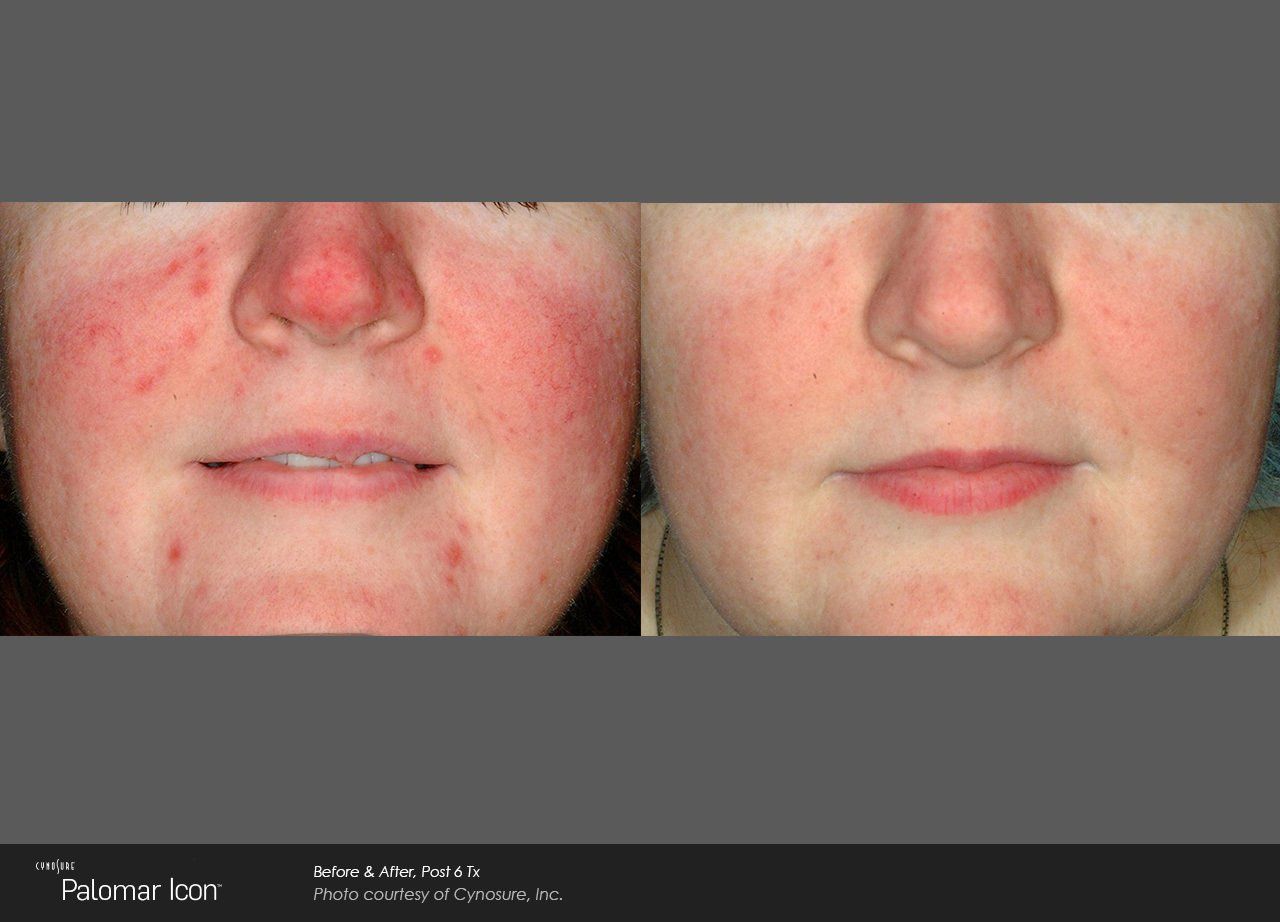 A before and after photo of a woman 's face