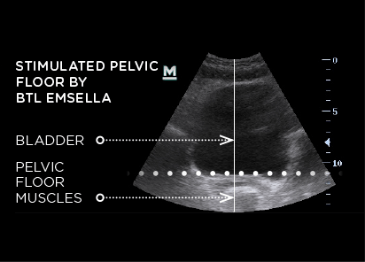 ultrasound after core to floor therapy