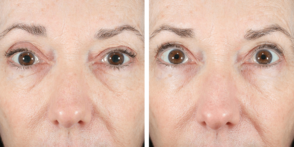 before and after treatment for skin tightening