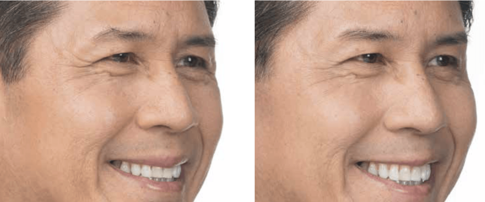 male patient before and after treatment with BOTOX® for moderate crows feet lines