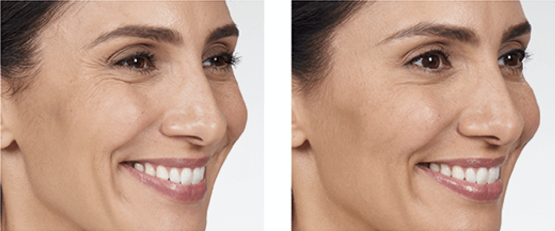 female patient before and after treatment with BOTOX® for moderate crows feet lines