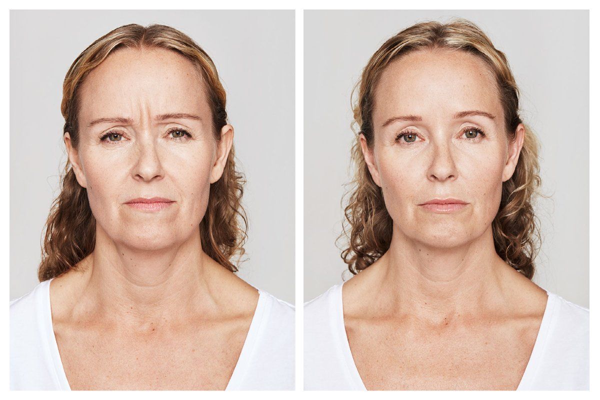 patient before and after treatment with Dysport® for forehead and crows feet lines