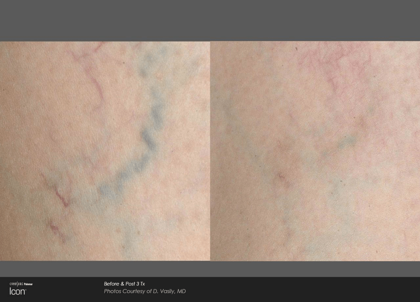 A before and after photo of varicose veins on a person 's leg