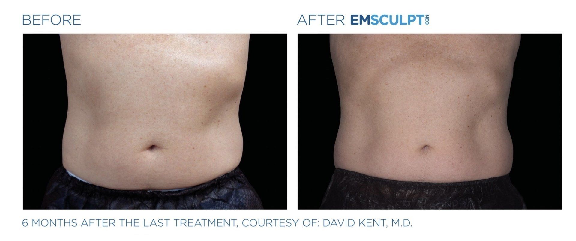 A before and after picture of a person 's stomach
