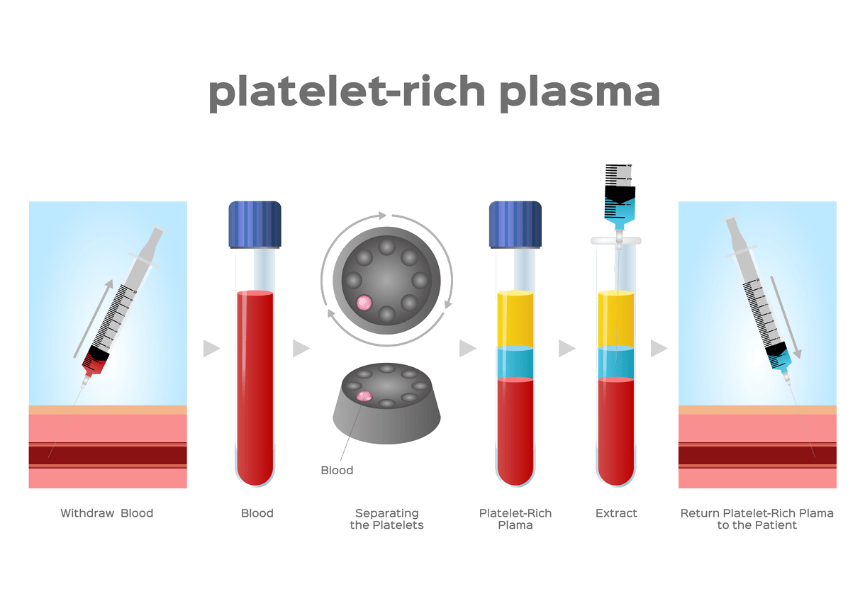 A diagram showing the process of platelet-rich plasma.