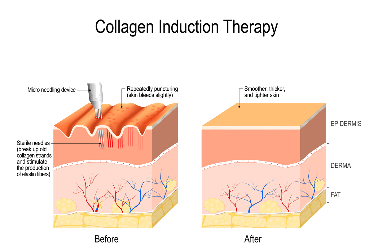 A diagram of a collagen induction therapy on a white background.