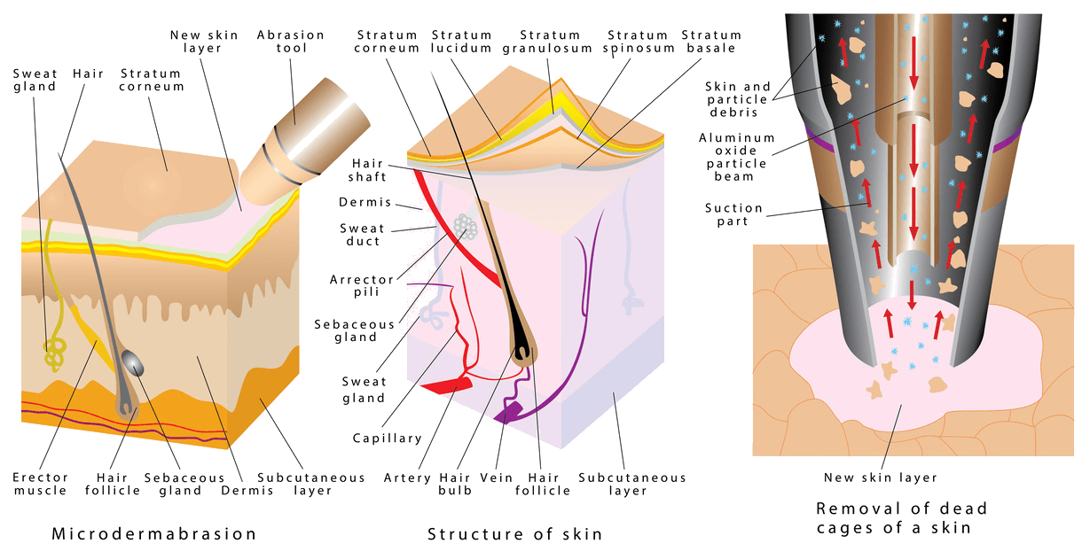 A diagram showing the process of hair removal