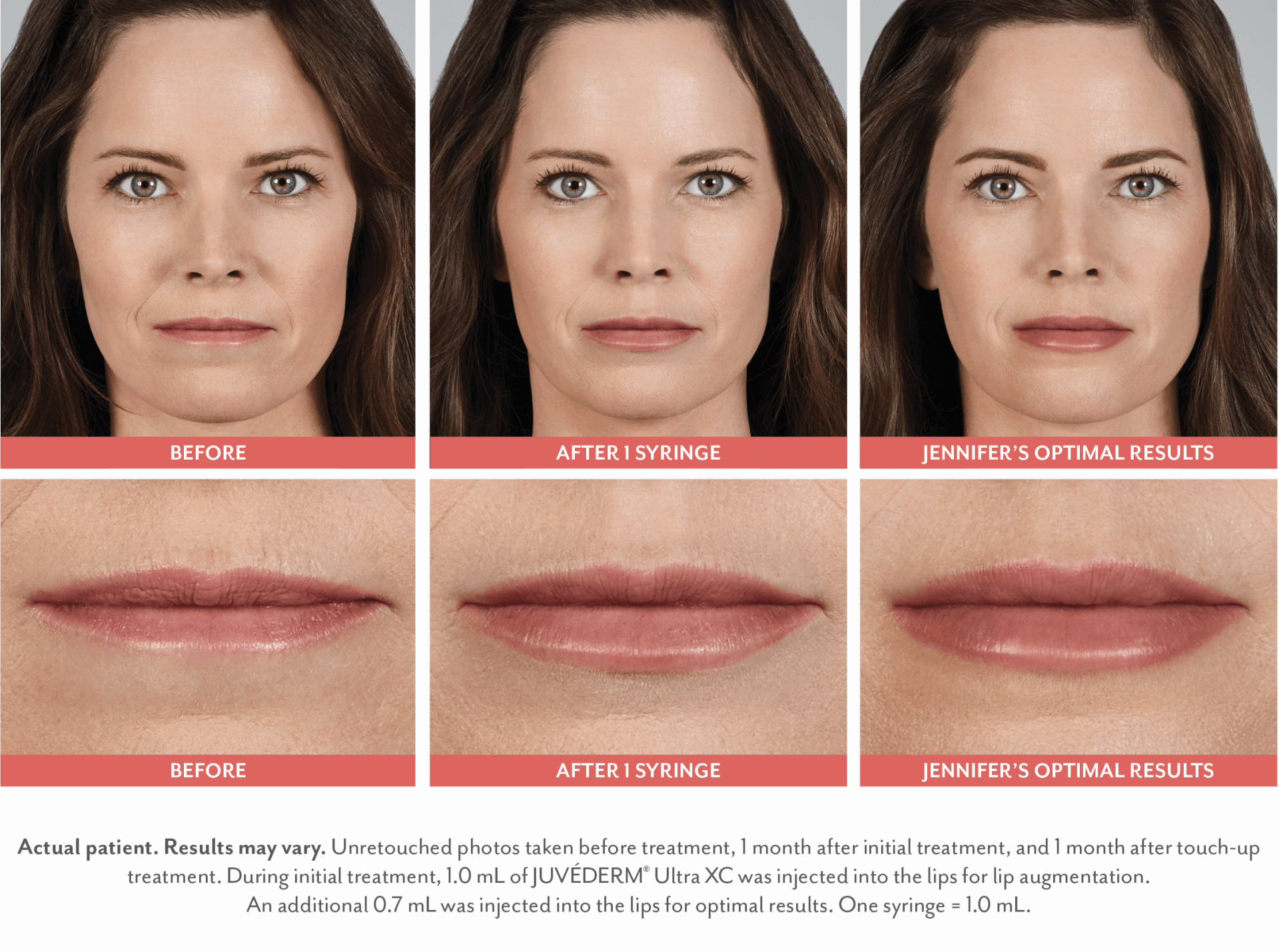 female patient before and after treatment with Juvederm dermal fillers