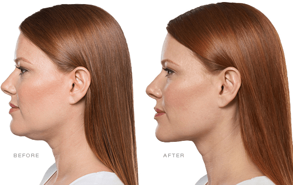 A before and after photo of a woman 's face.