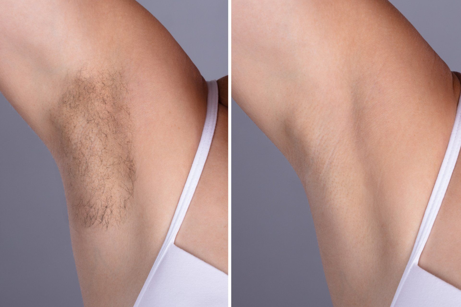 laser hair removal before and after