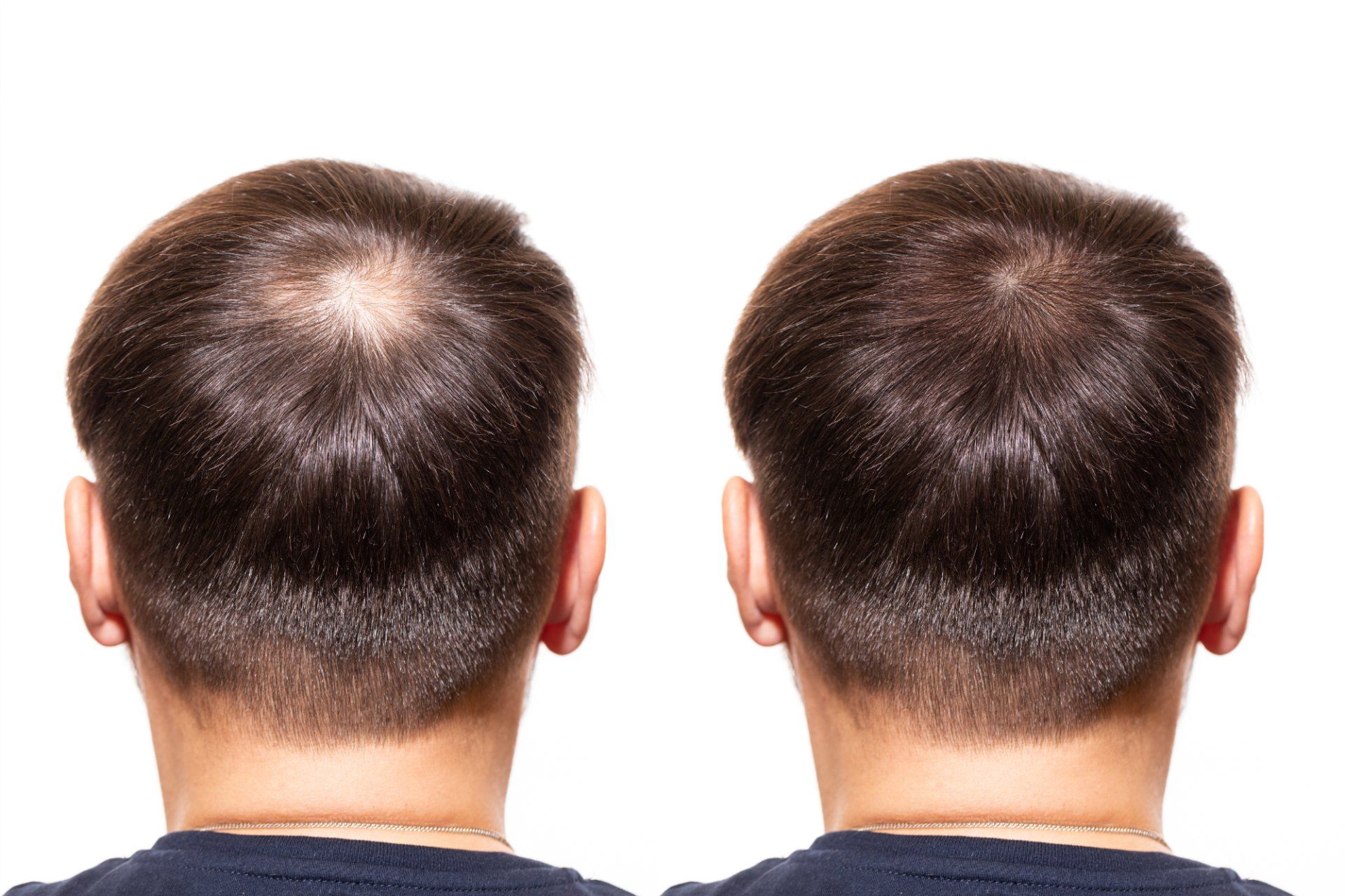 The back of a man 's head before and after hair loss treatment.