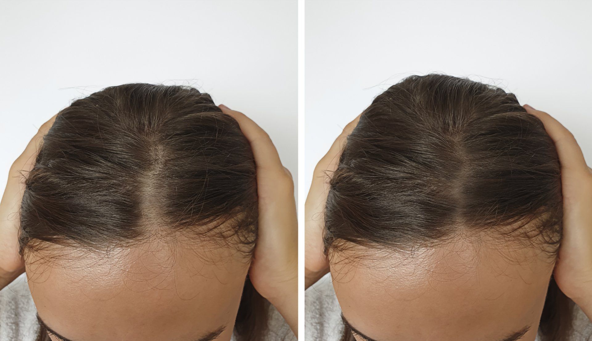 before and after hair loss treatment