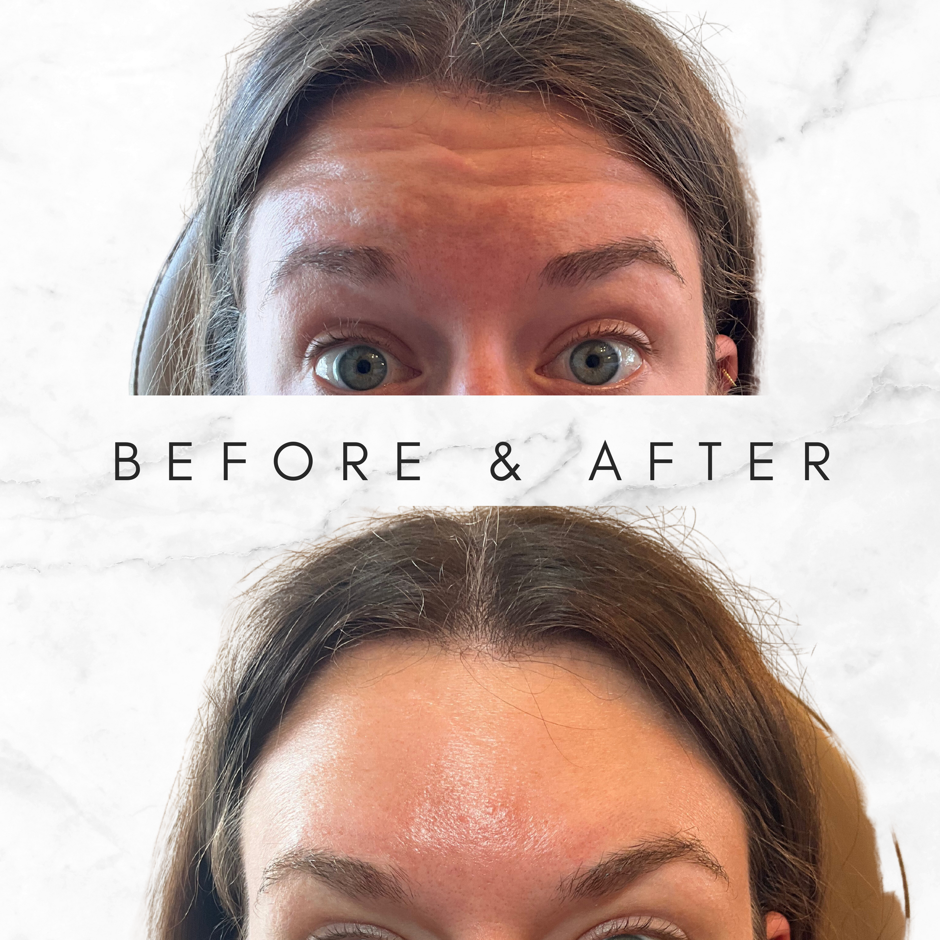 A before and after photo of a woman 's forehead