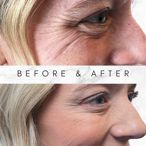 A before and after photo of a woman 's face with wrinkles.