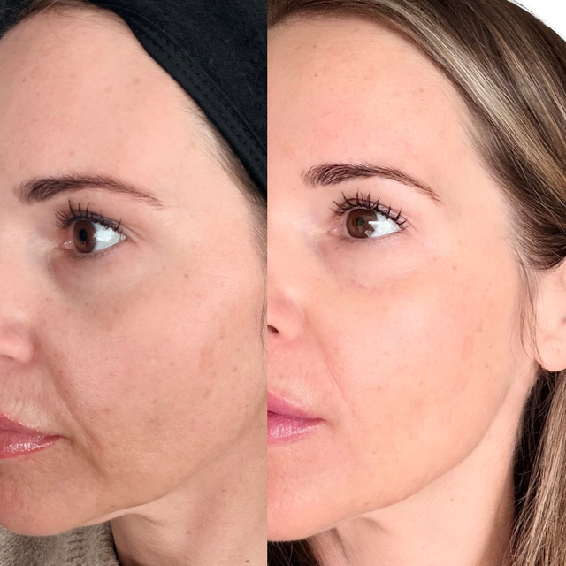 glutathione microneedling before and after Health & Beauty Clinic | Westfield, IN Jupiter by Kromasol - Advanced Vita Glow Glutathione Night Cream Size:40 Serves