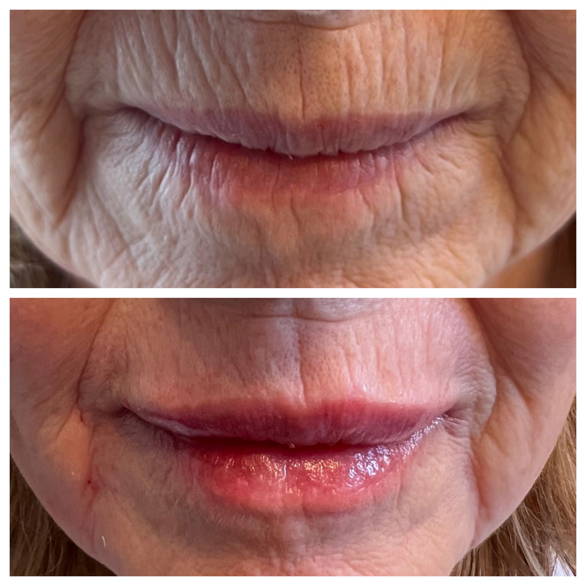 A before and after picture of a woman 's lips.