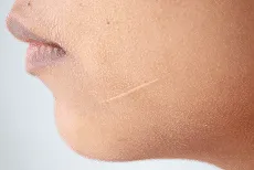 clear scars
remove scars
scar gel that works